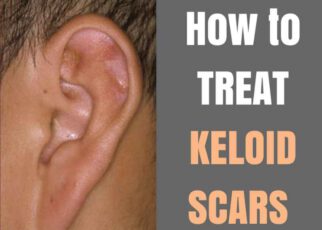 What Is The Best Treatment For Ear Keloid?