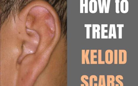 What Is The Best Treatment For Ear Keloid?