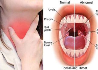 Differences Between Tonsillitis And Streptococcal Infection