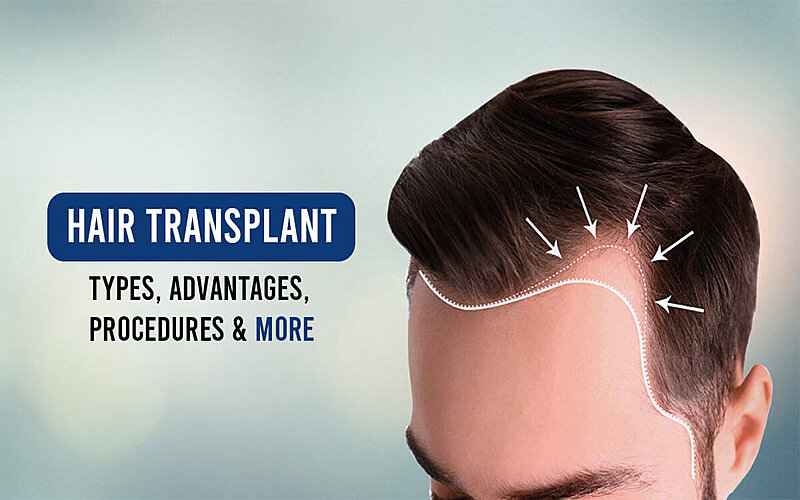 What is Hair Transplantation?