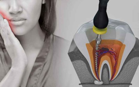 Root Canal Therapy, Dental, Teeth Tips